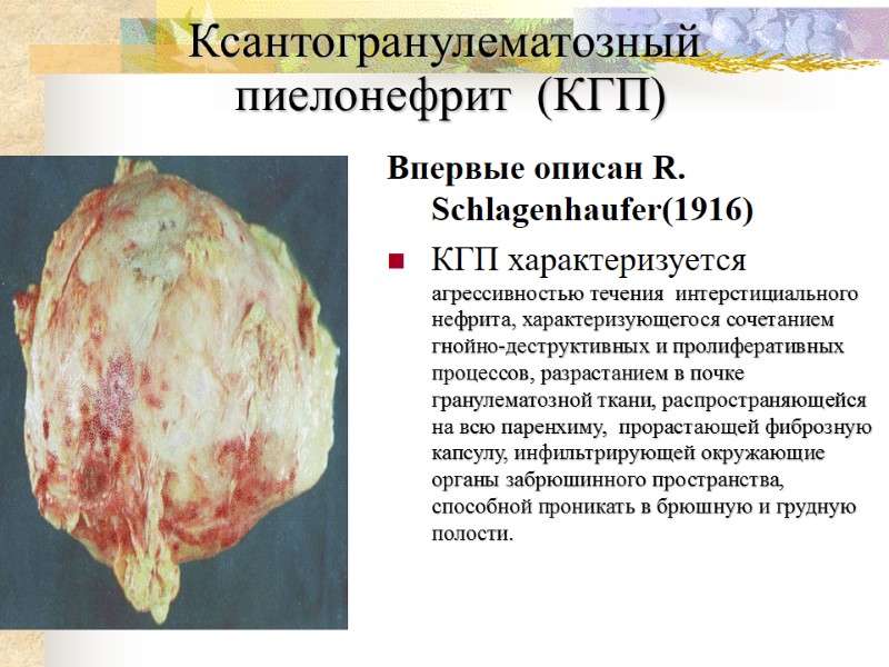 Ксантогранулематозный      пиелонефрит  (КГП) Впервые описан R. Schlagenhaufer(1916) КГП